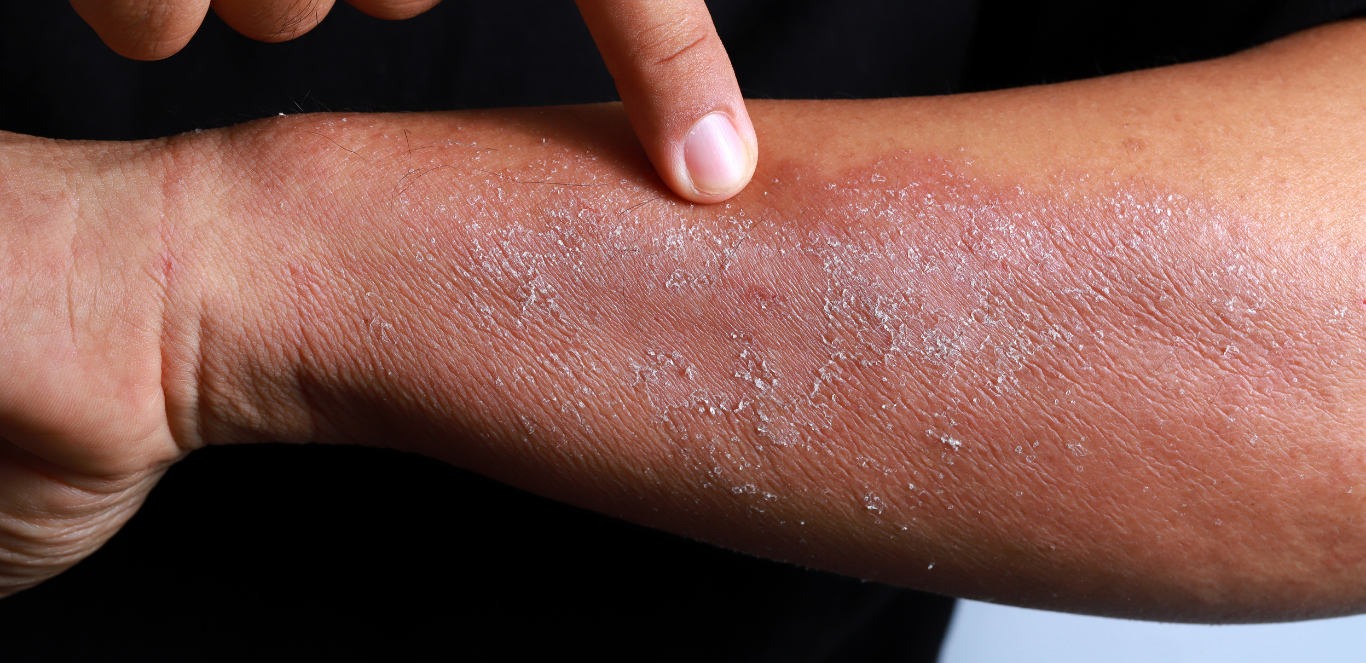 World Atopic Eczema Day – September 14